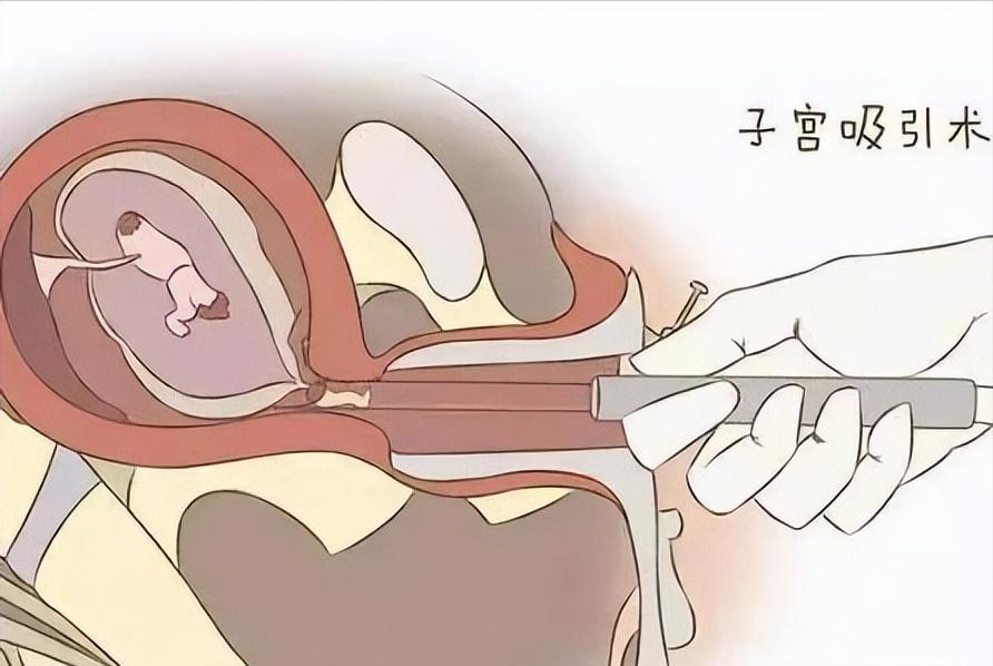 无痛人流真的这么轻松吗,无痛人流真的不疼的吗
