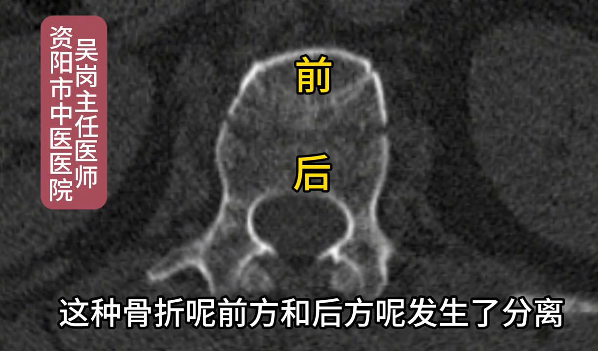 腰椎受伤造成压缩性骨折怎样治疗,腰椎骨折哪种情况适用于微创手术