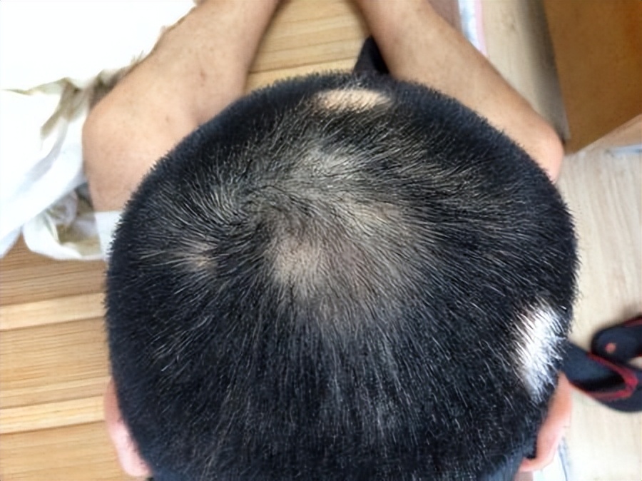 治疗脱发最有效的方子,一招帮你解决所有脱发问题