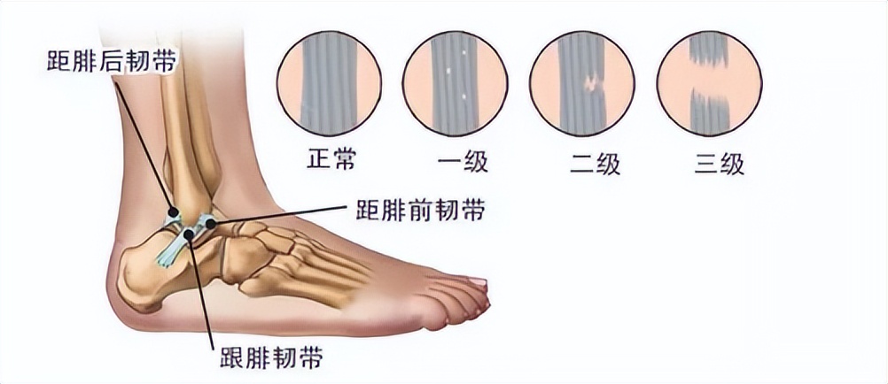 脚踝扭伤的处理方法和注意事项,轻度脚踝扭伤的处理方法及康复