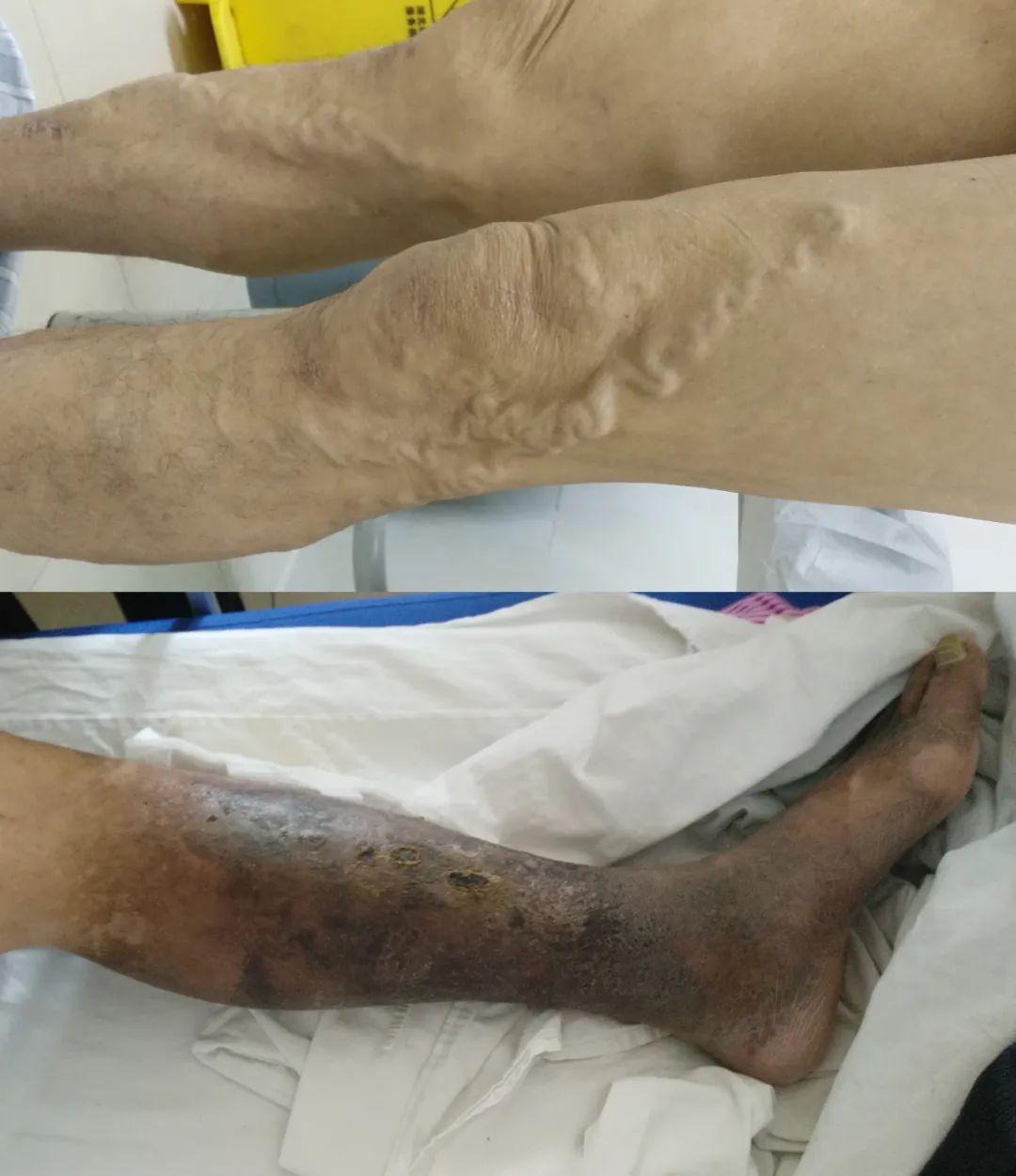 如何治疗静脉血栓,怎样治疗静脉血栓