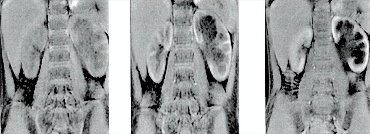 中医治疗宝宝肾积水输尿管狭窄,小儿肾积水和输尿管扩张怎么治疗