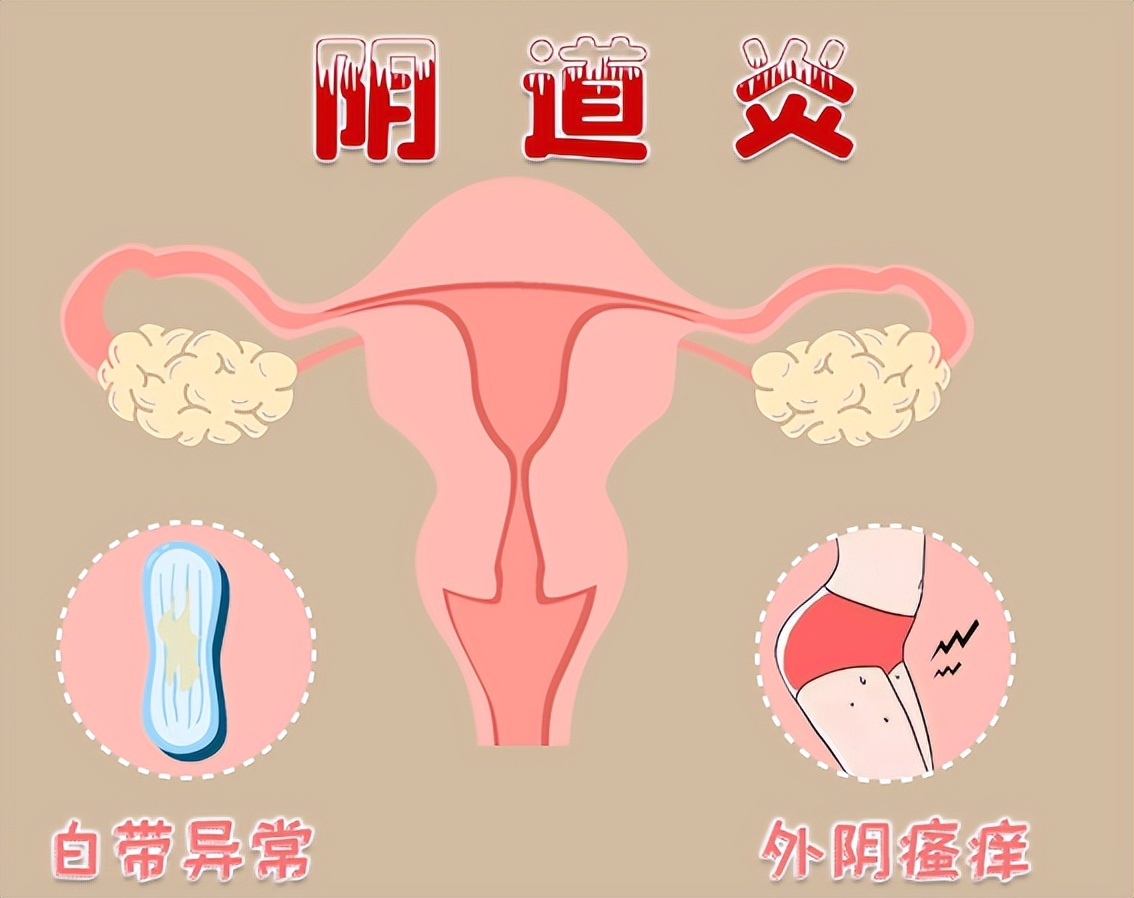 分泌物多阴部瘙痒是什么原因,下体瘙痒症