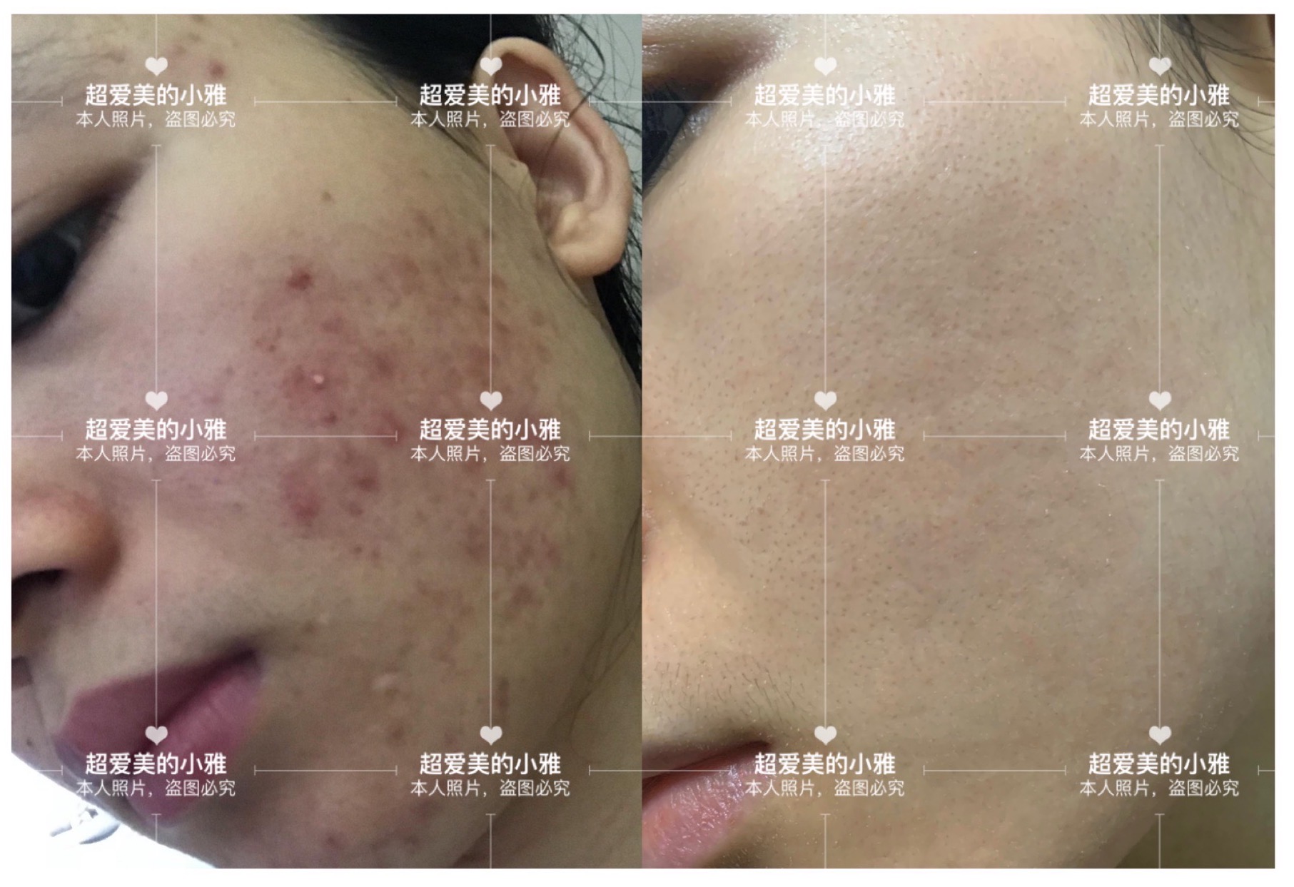 痘痘严重爆发如何战痘到底,痘痘的常见问题解决方法在这里