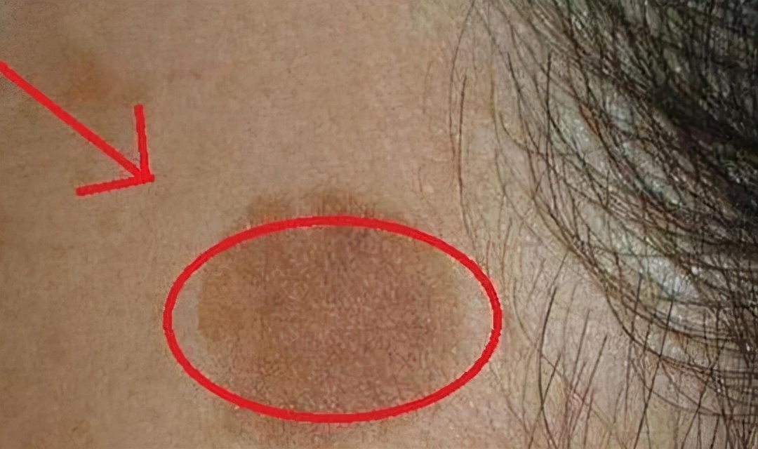 用红霉素软膏可以祛除老年斑吗,红霉素软膏消除老年斑