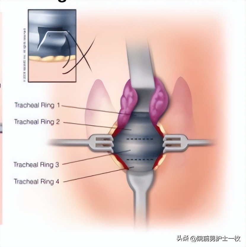 关于气管切开技术流程及注意事项