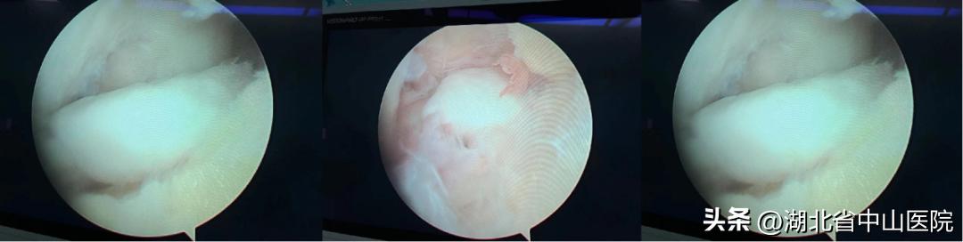 【中山医“声”】膝盖“卡壳”是怎么回事？原来是游离体在捣乱