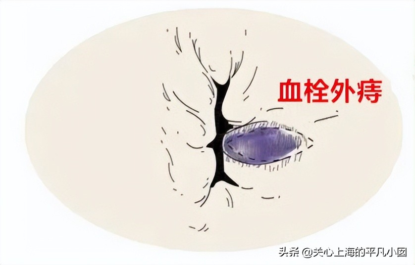 痔疮肛门裂老痛怎么治,肛门小尾巴痛是痔疮吗