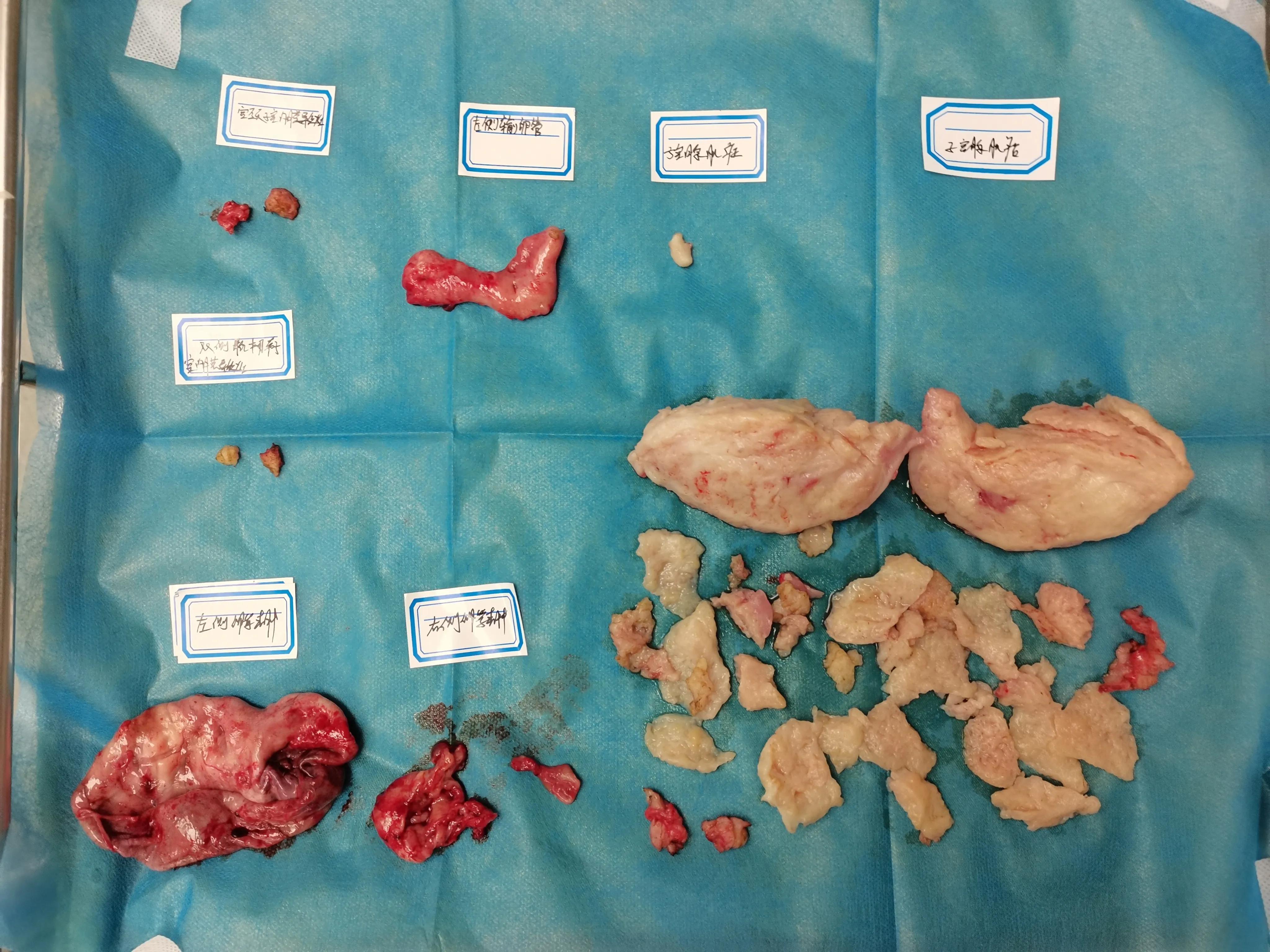 广西34岁女人腺肌症,陈女士的抑郁症