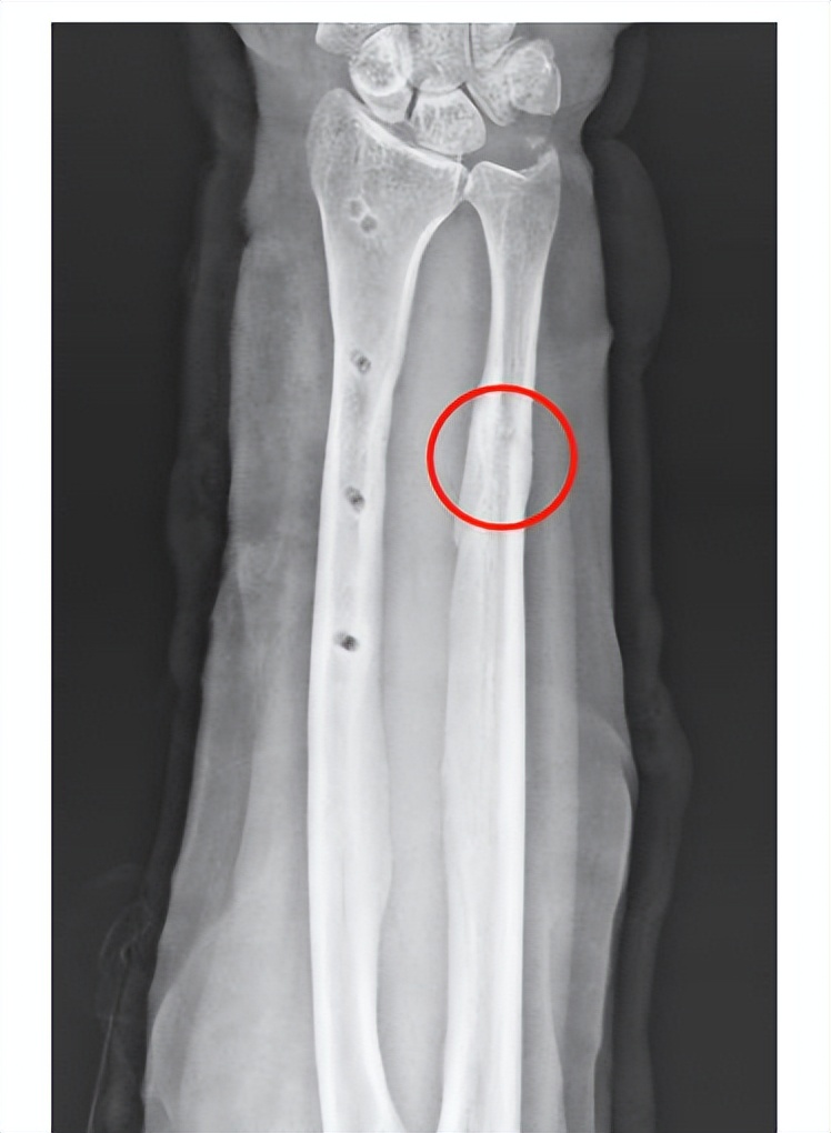 治疗骨折新技术,微创手术治疗骨折的方法