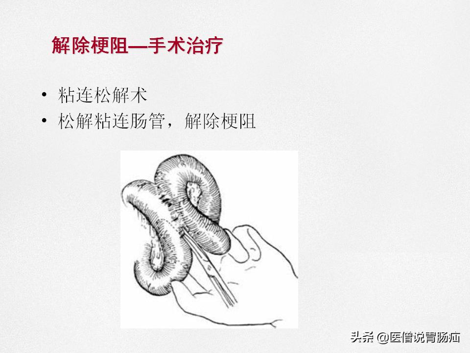 肠梗阻健康教育,肠梗阻患者的健康宣教