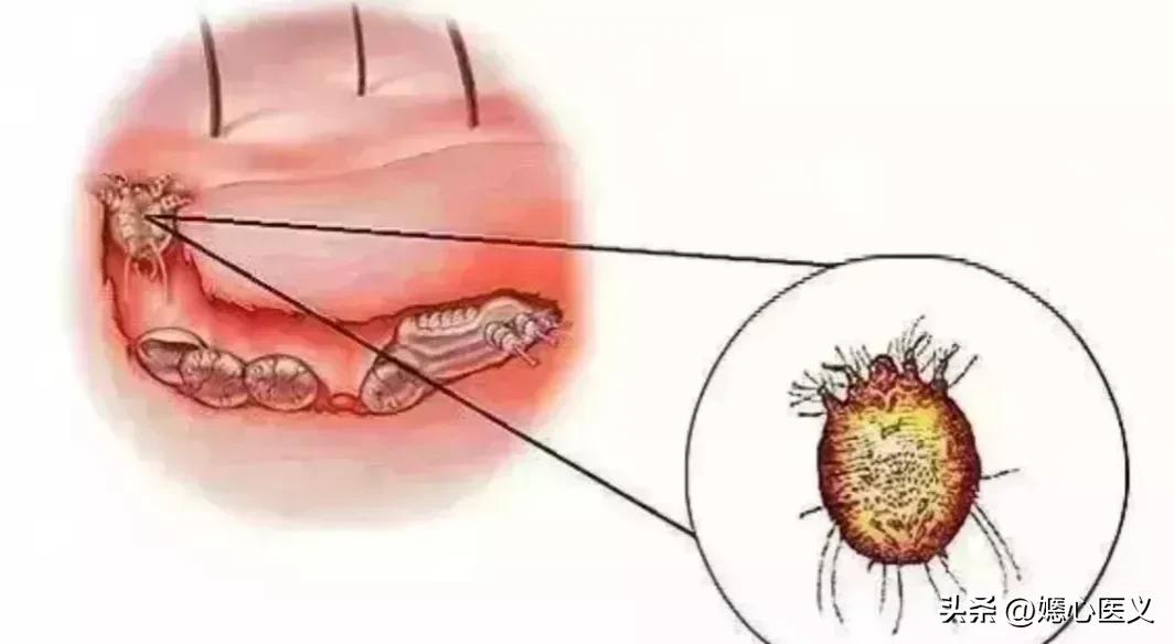 皮肤病疥疮是什么症状,疥疮被传染的最初症状