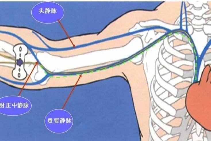 不扎针的输液管,不扎留置针静脉输液