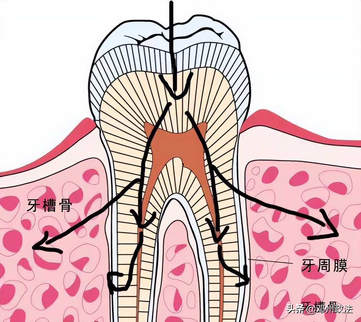 门牙龅牙松动做烤瓷牙还是种植牙,种植牙和烤瓷牙哪个比较逼真好看