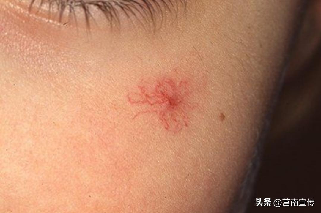 身上长这几个小红点是癌症,身上长了红点看什么科