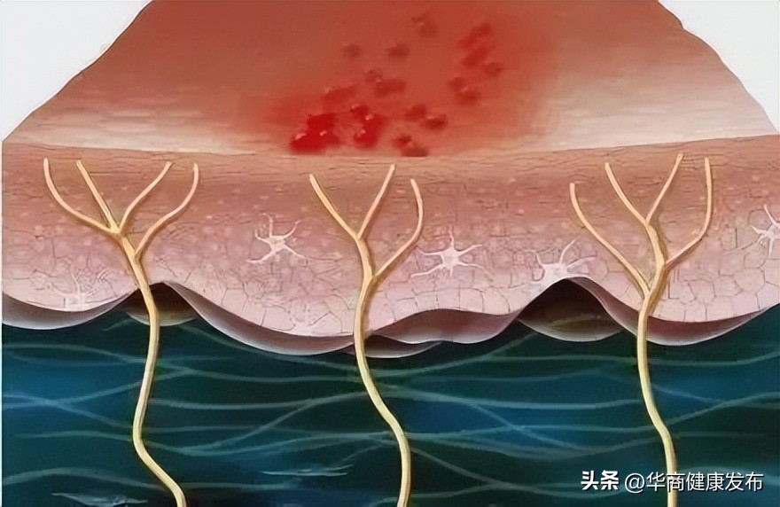 带状疱疹怎么办,孕妇得了带状疱疹怎么办