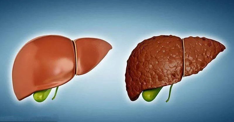 肝硬化出现结节肝硬化还能逆转吗,肝硬化干细胞移植能逆转肝硬化吗
