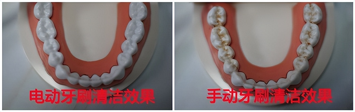 儿童电动牙刷u型好还是普通的好,儿童长期使用电动牙刷的三大危害