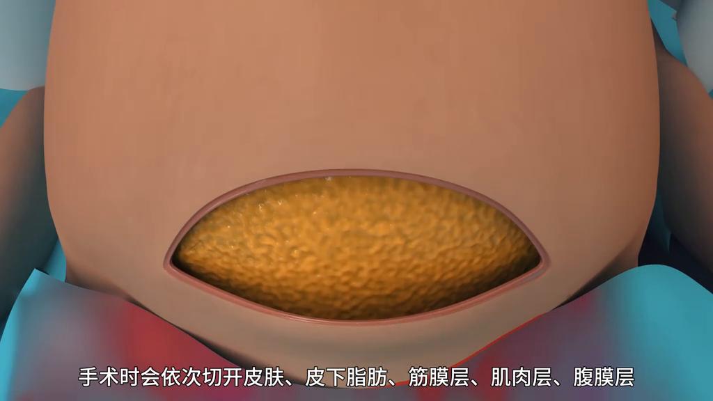 剖腹产手术全部流程真实的,剖腹产手术实操全部流程