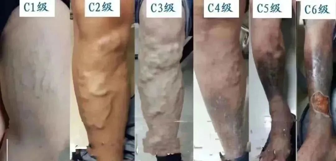 静脉曲张蚯蚓腿怎么回事,静脉曲张多久会形成蚯蚓腿