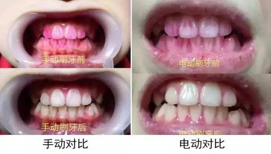 儿童电动牙刷是智商税吗,可视智能电动牙刷是智商税吗