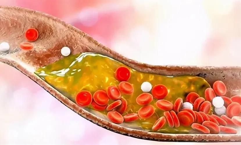 发现动脉硬化还能活多久,发现血管斑块是不是就是脑梗了