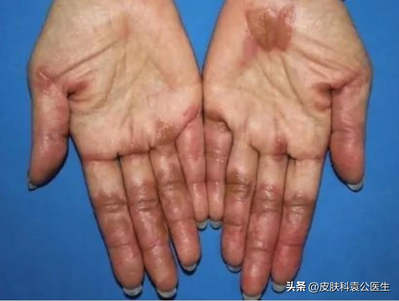 靶向加免疫治疗皮疹怎么处理,服用靶向药起皮疹怎么办