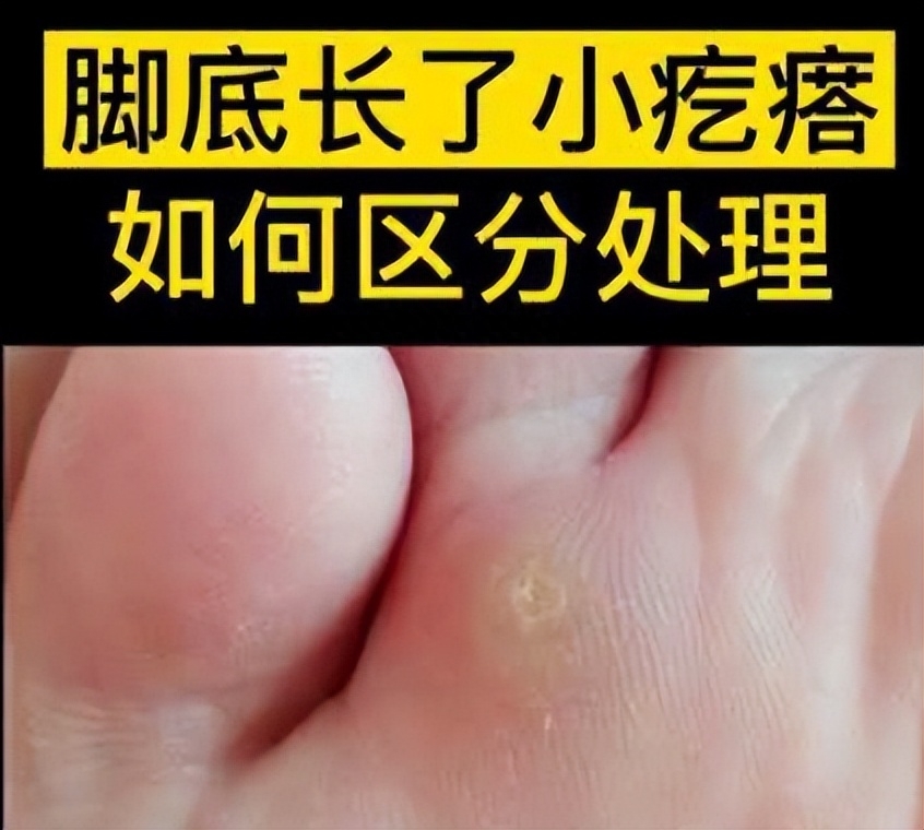 脚上长了类似瘊子又像老茧的东西,长在脚上的鸡眼和疣的区别