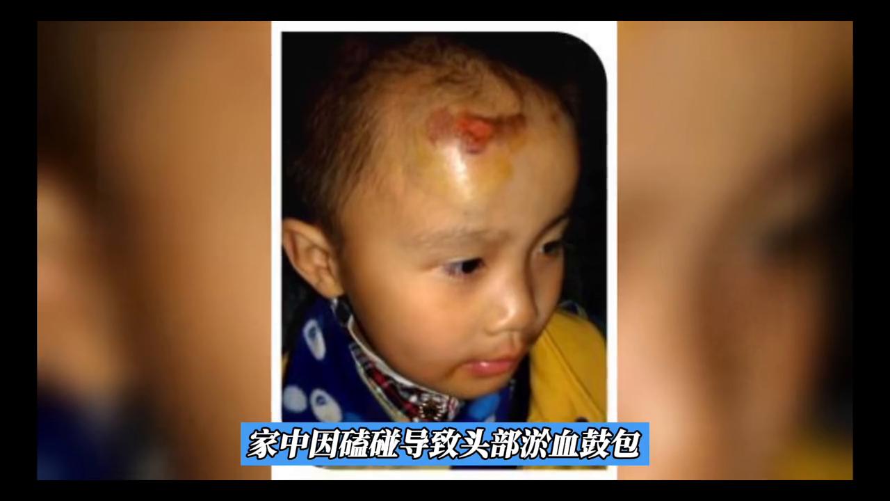 小孩头部淤血鼓包多久恢复,医生指定到外面买天价药