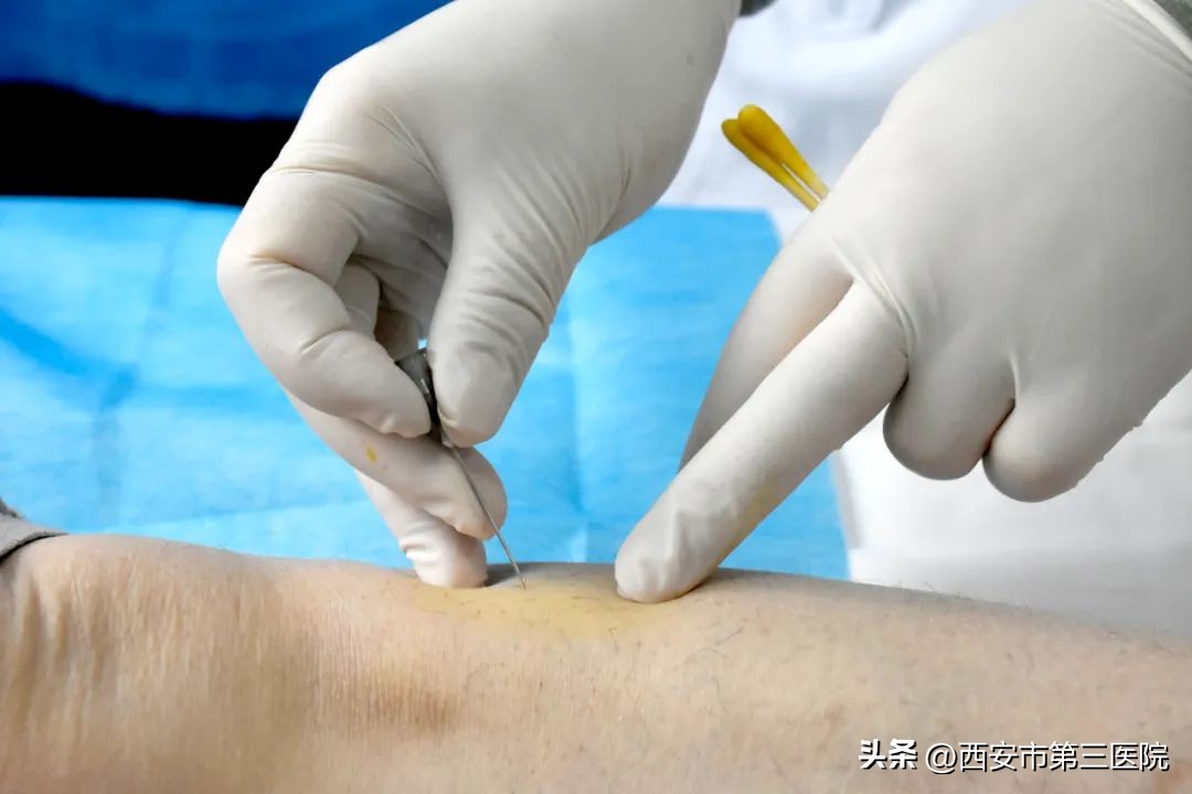 腹部穴位埋线减肥有效果吗,穴位埋线减肥一斤不减