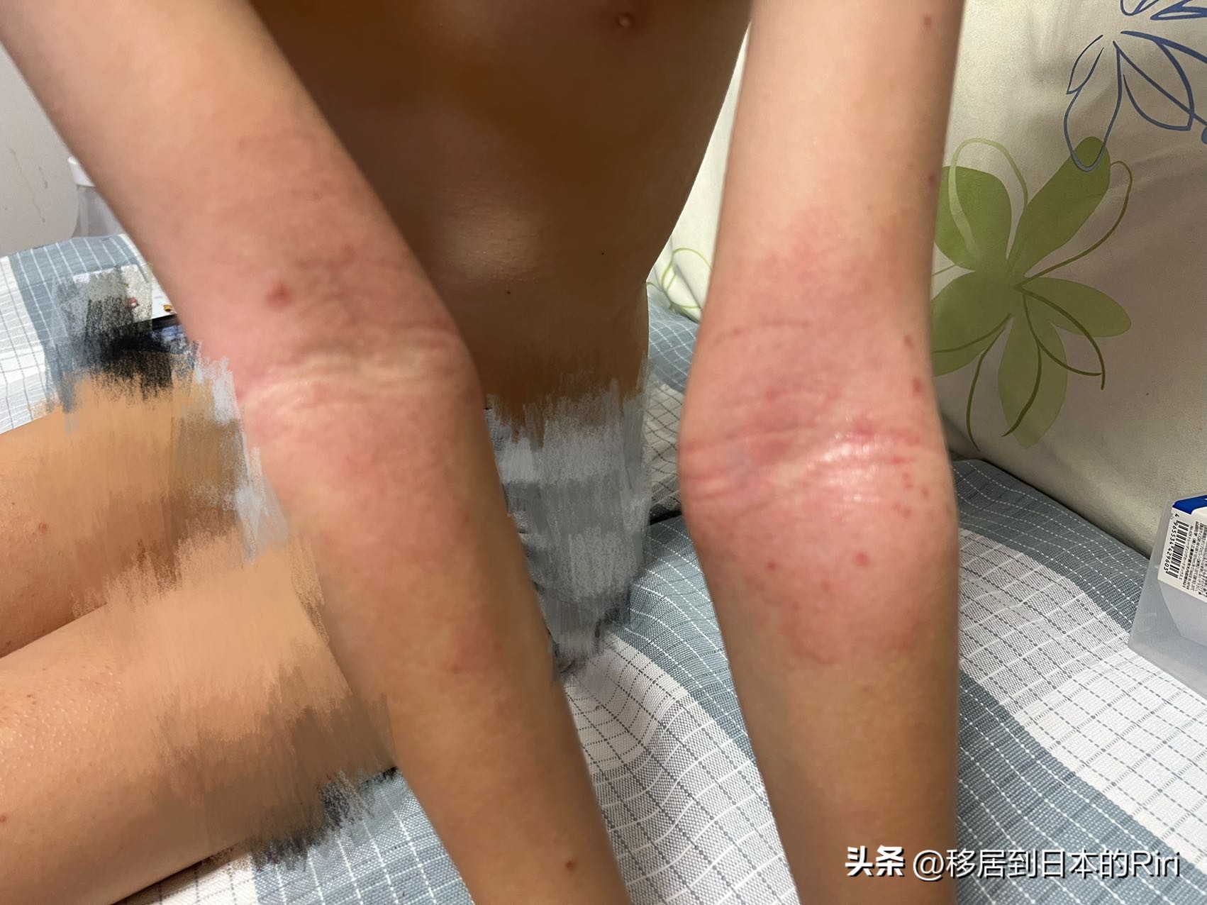 日本神经性皮炎,日本过敏性皮炎