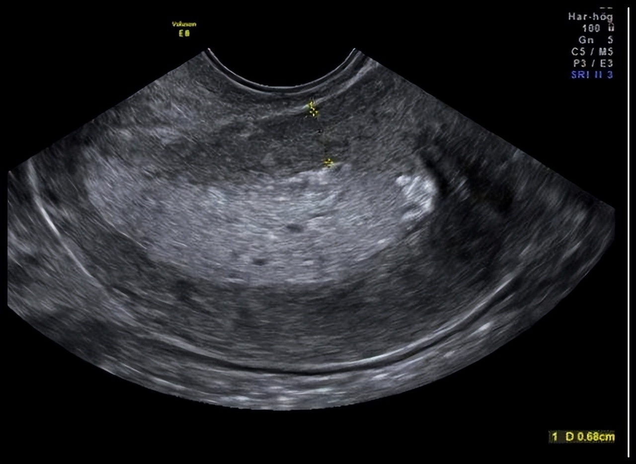 人流后子宫内膜回声不均匀啥意思,子宫内膜厚度12mm回声不均匀