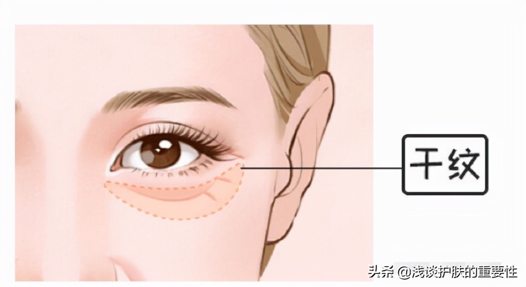 眼纹明显皮肤松弛显老,眼纹显老怎么办