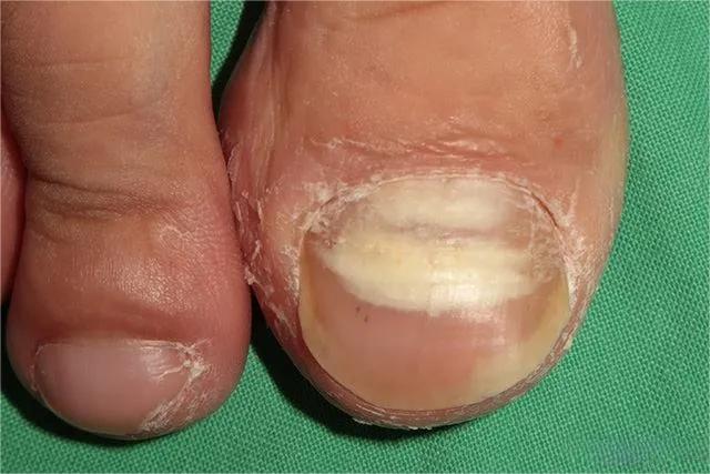 甲癣不严重怎么治疗,甲易生治疗灰指甲吗