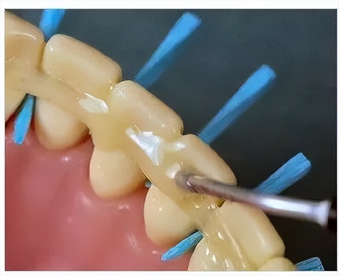 牙龈出血牙齿松动最佳补救方法,牙龈出血牙齿松动怎么办