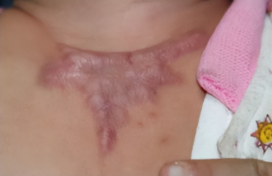 烧烫伤疤痕如何修复？烧烫伤疤痕怎么治疗？