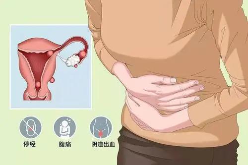 怀孕早期肚子痛就一定是宫外孕吗,怀孕早期有腹痛需要保胎么