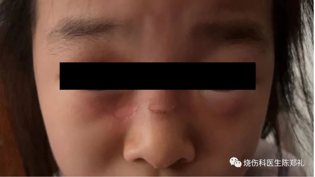 放烟花伤了人怎么办,鞭炮炸伤面部轻微怎么处理不留疤