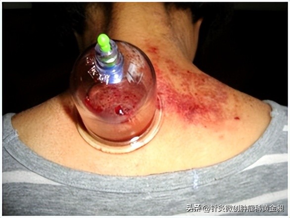 儿童颈部淋巴结怎么消除,放疗能消除颈部淋巴结吗