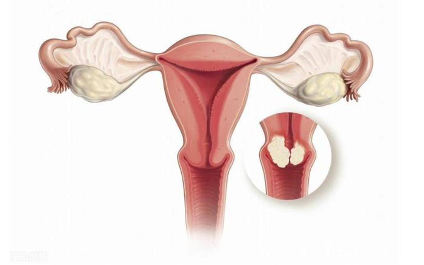 女子确诊宫颈癌，子宫全切！提醒：身体这3处异常变化，别再忽视