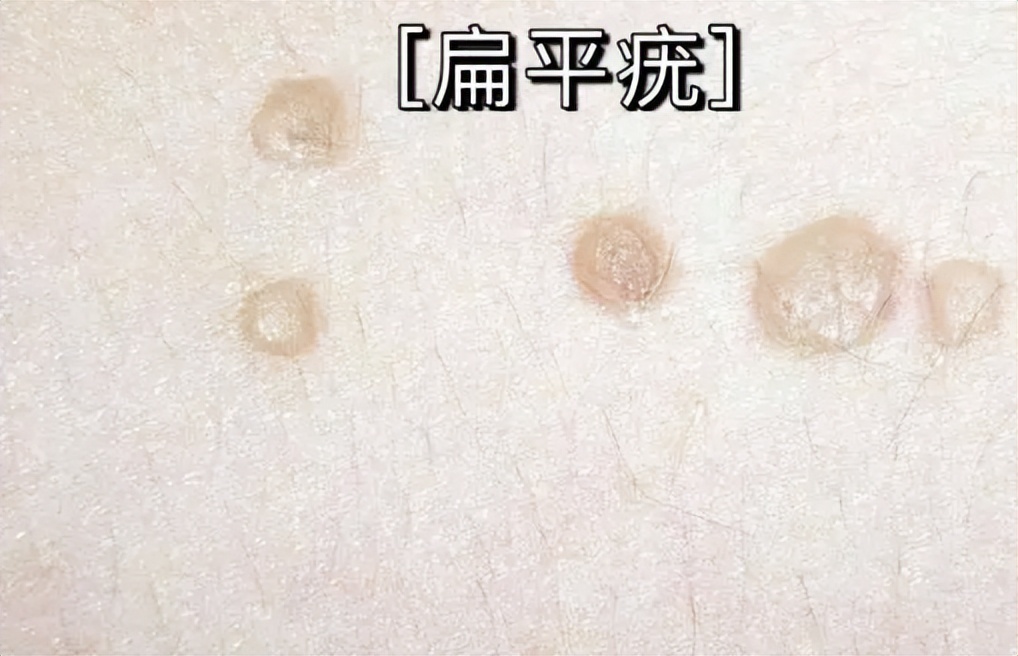 皮肤长了个凸起的小肉球怎么去除,皮肤长的小肉球怎么自己处理