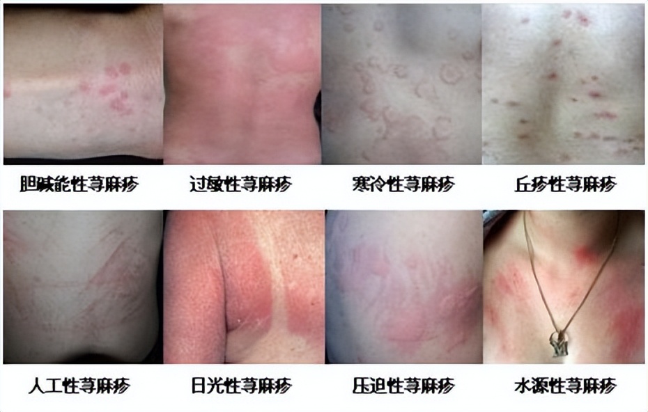荨麻疹常识,荨麻疹知识