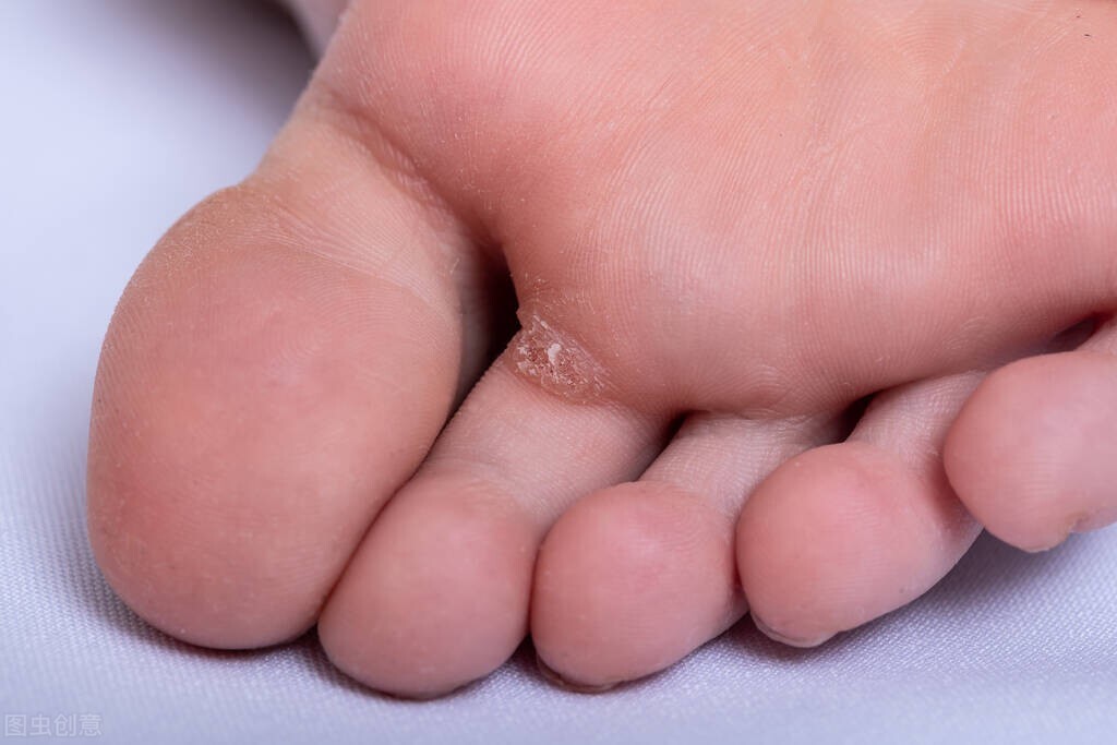 鸡眼和跖疣的区别该怎么治疗,鸡眼跖疣怎么去除最有效