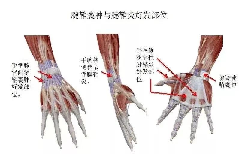 一招治腱鞘炎,脚部腱鞘炎三个动作自愈方法