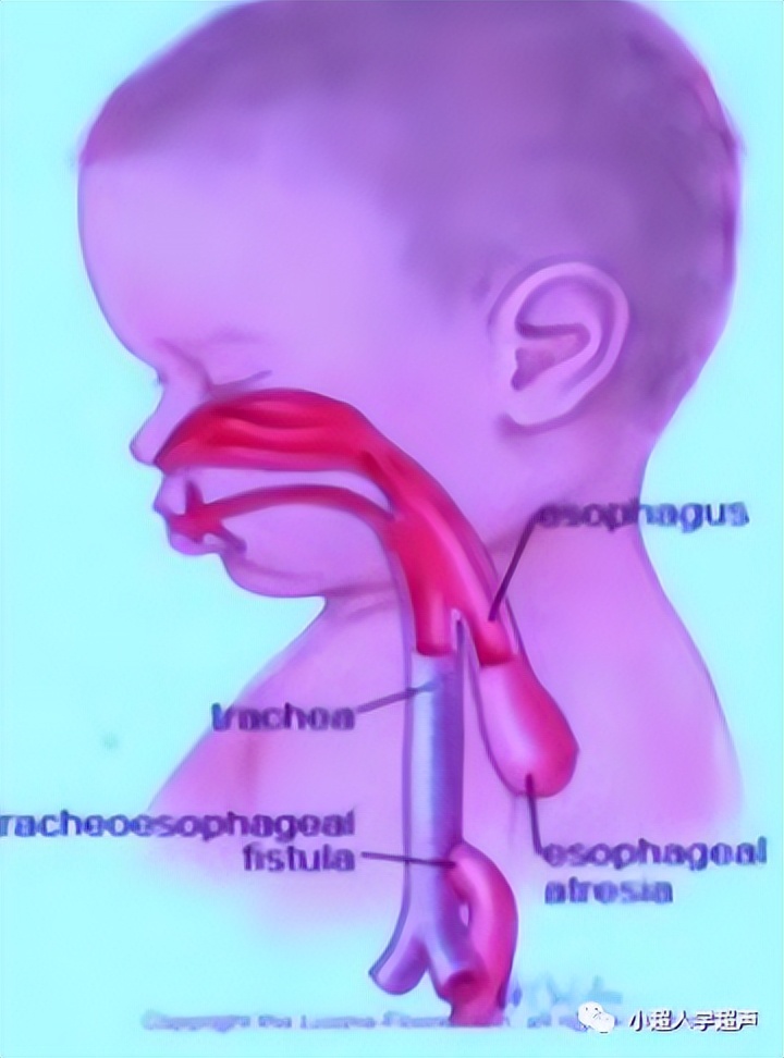 超声影像小视频,食道闭锁超声表现