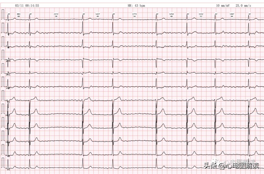心房颤动伴长间歇能做射频消融吗,心房颤动伴停搏严重么