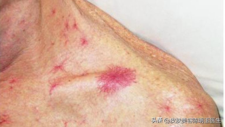 皮肤长红痣是肝有毛病,身上长出红痣是肝脏出了问题吗