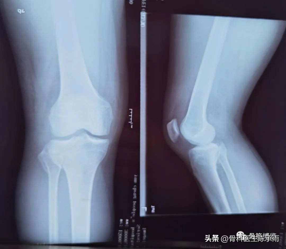 膝关节胫骨平台骨折,最近胫骨平台骨折视频