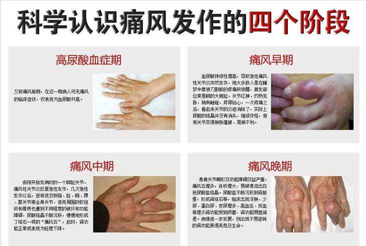 痛风怎么治15个字全搞定,痛风怎么治疗才能好得快