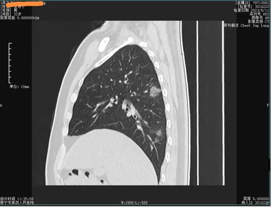 新冠复阳会感染吗,新冠复阳还是二次感染